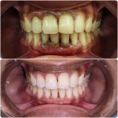 Patient case at Rifadel Dental