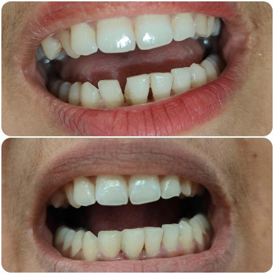 Patient case at Rifadel Dental