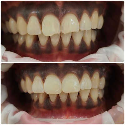 Patient case at Rifadel Dental